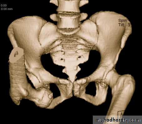 DISLOCATION OF HIP