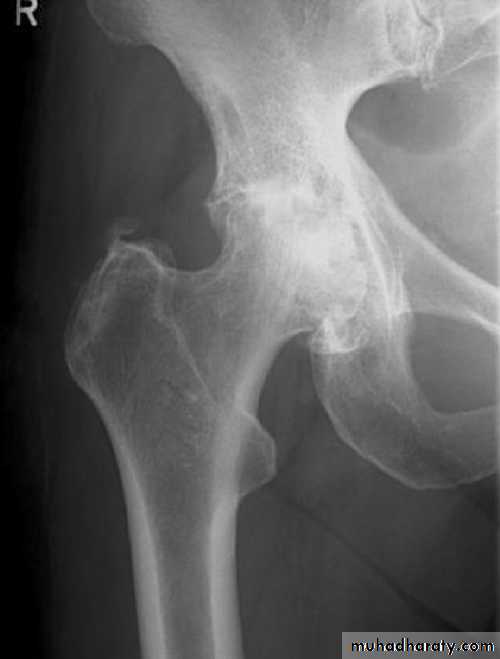 DISLOCATION OF HIP