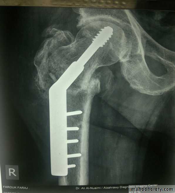 DISLOCATION OF HIP