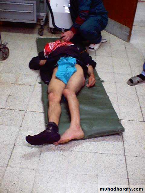 DISLOCATION OF HIP
