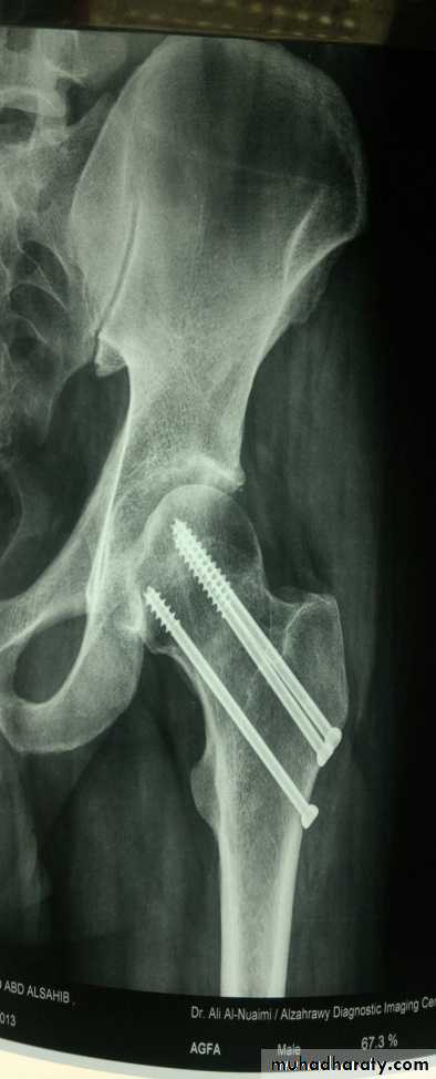 DISLOCATION OF HIP
