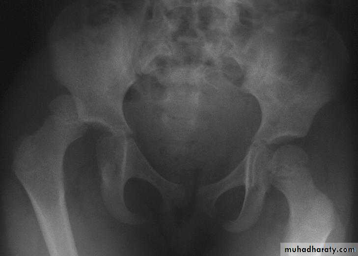 DISLOCATION OF HIP