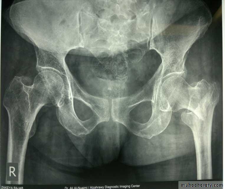 DISLOCATION OF HIP