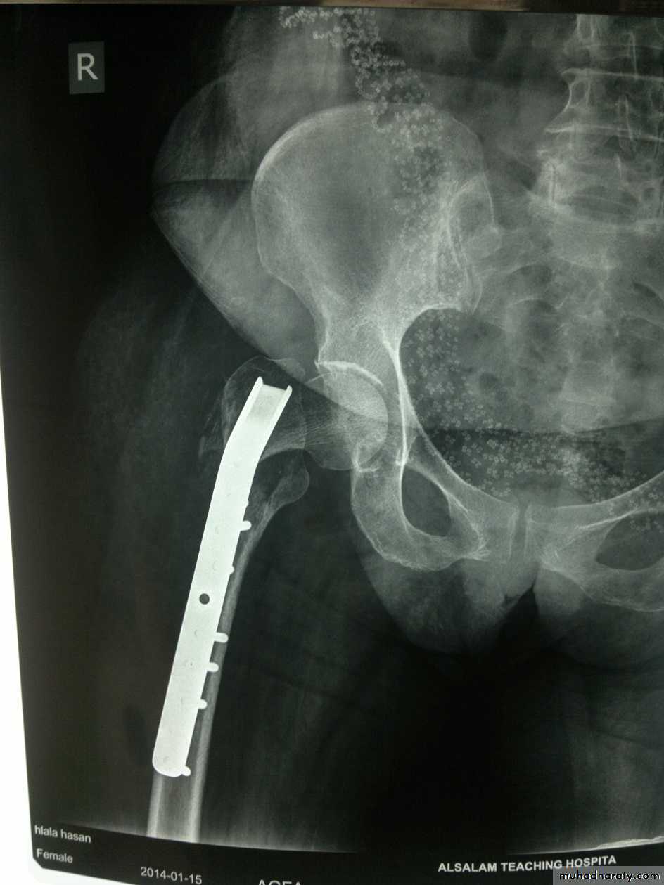 DISLOCATION OF HIP