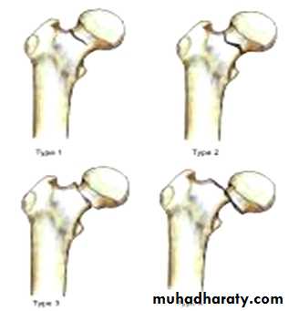 DISLOCATION OF HIP