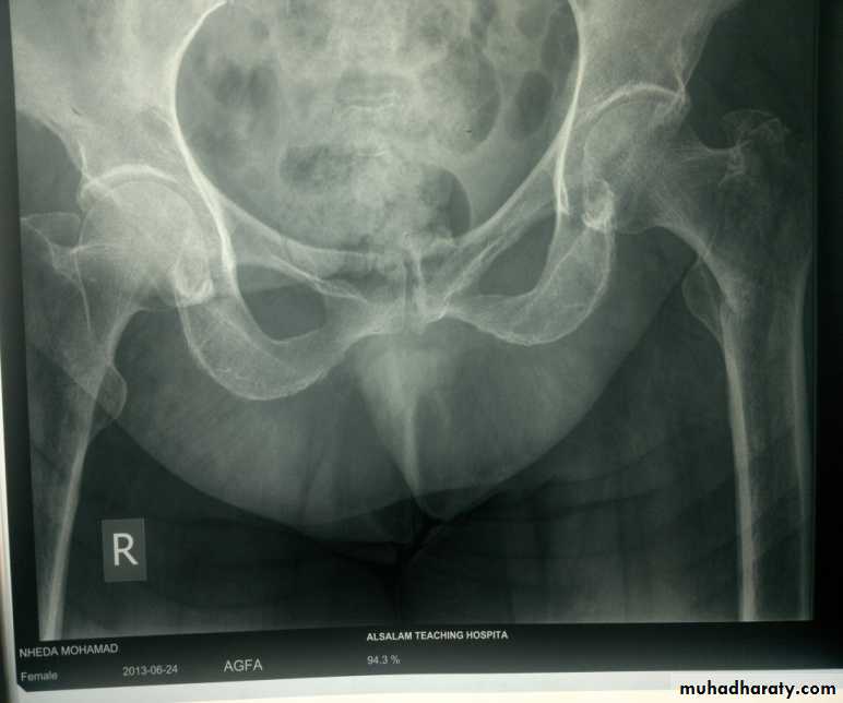DISLOCATION OF HIP