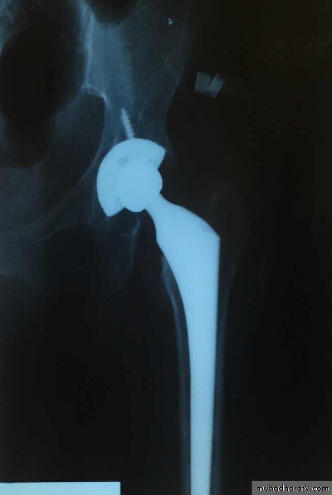 DISLOCATION OF HIP