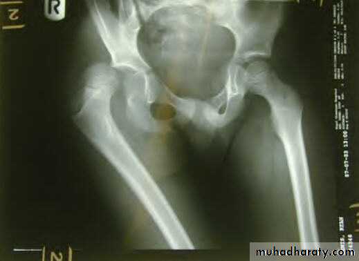 DISLOCATION OF HIP