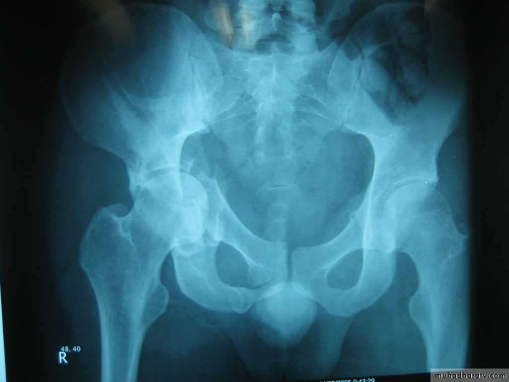 DISLOCATION OF HIP