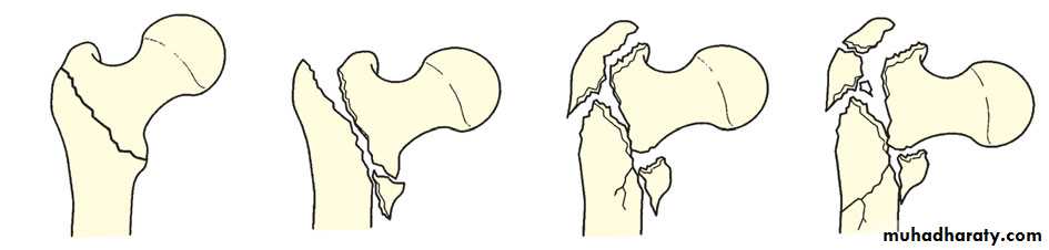 DISLOCATION OF HIP