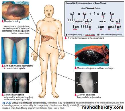 Bleeding disorders