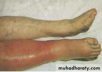Bleeding disorders