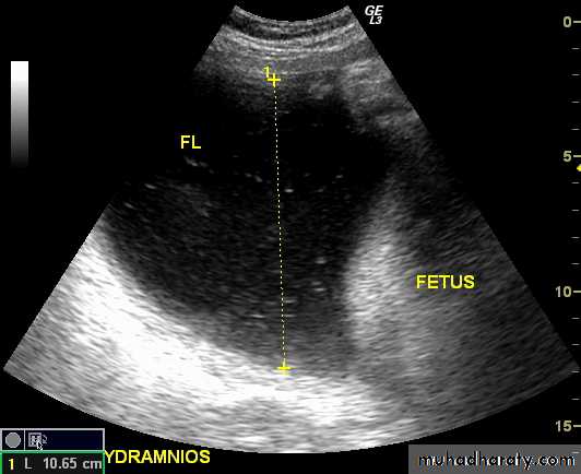Ultrasound in Obestatric