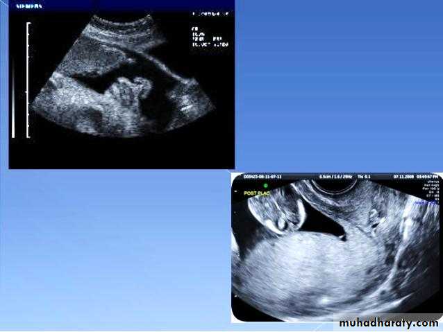 Ultrasound in Obestatric
