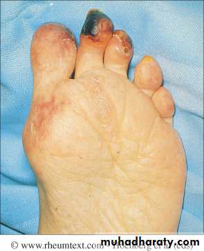 Systemic Connective Tissue Disease