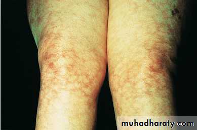 Systemic Connective Tissue Disease