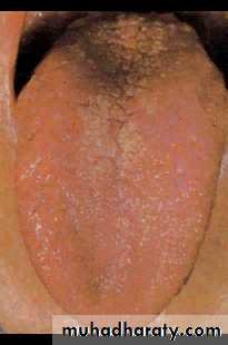 Systemic Connective Tissue Disease