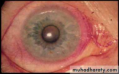 Systemic Connective Tissue Disease