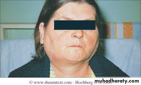 Systemic Connective Tissue Disease