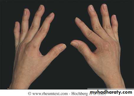 Systemic Connective Tissue Disease
