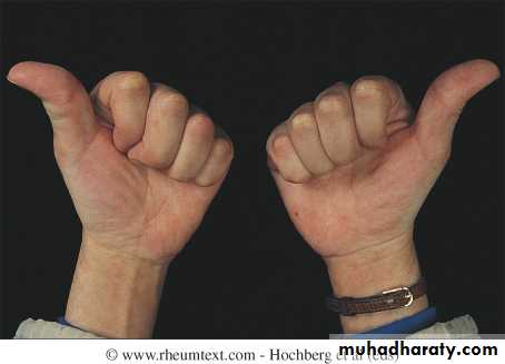 Systemic Connective Tissue Disease
