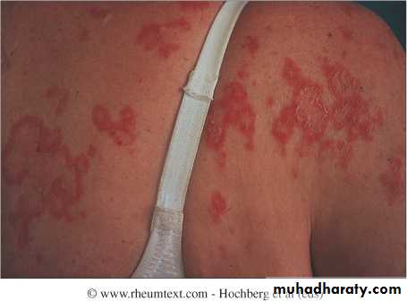 Systemic Connective Tissue Disease