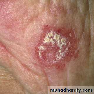 Systemic Connective Tissue Disease