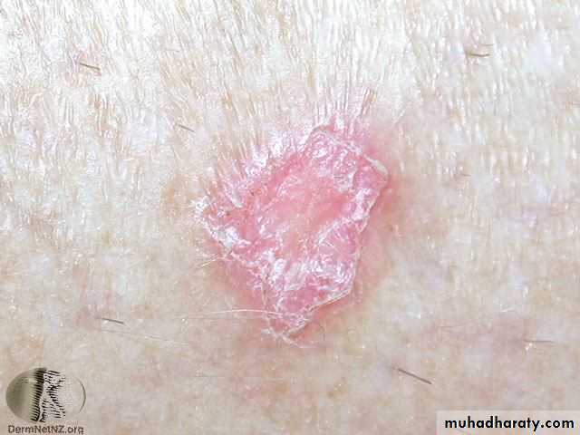 Systemic Connective Tissue Disease