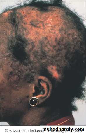 Systemic Connective Tissue Disease