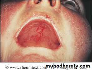 Systemic Connective Tissue Disease