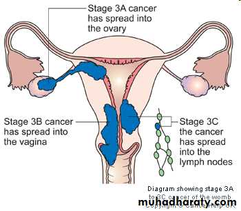 malignant uterus