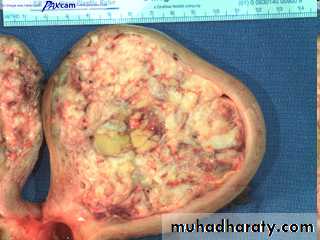 malignant uterus