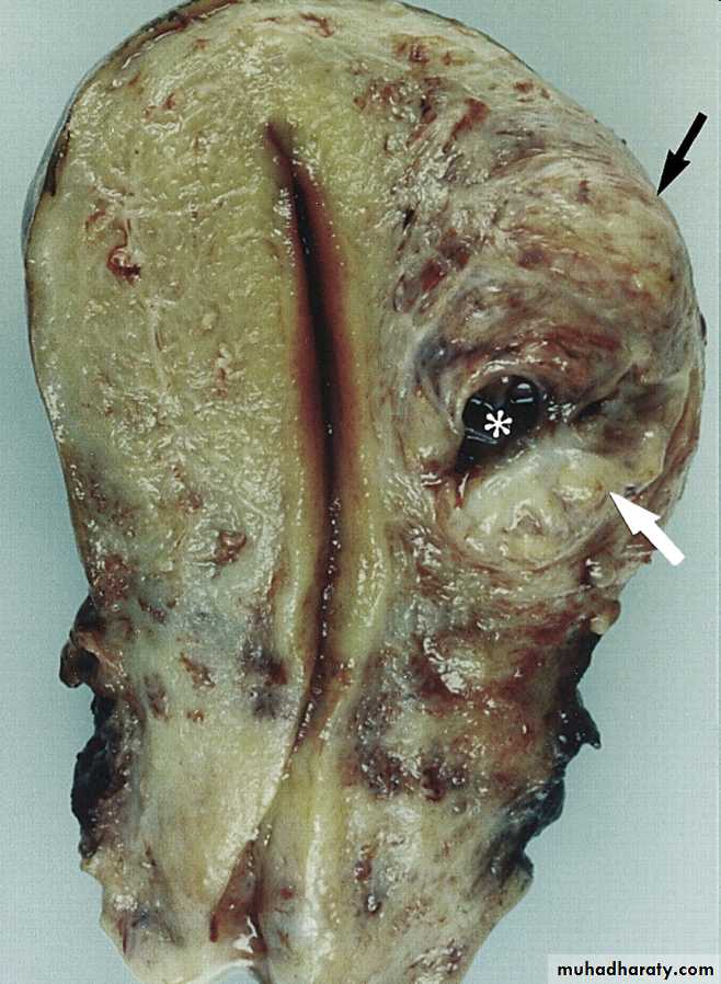 malignant uterus