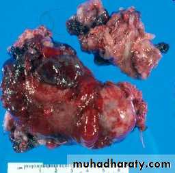 malignant uterus