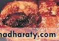 malignant uterus