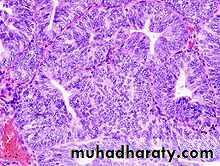 malignant uterus