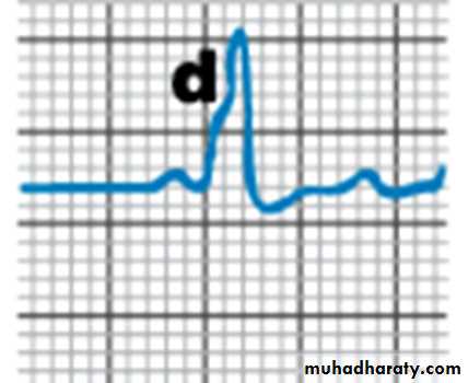 ECG