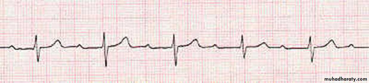 ECG