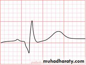 ECG