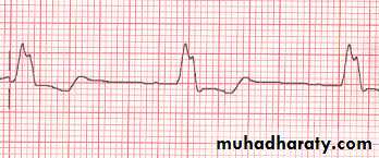 ECG