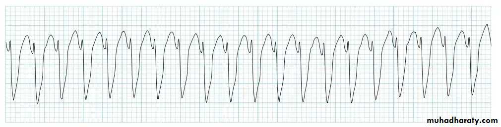 ECG