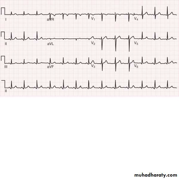 ECG