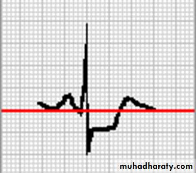 ECG