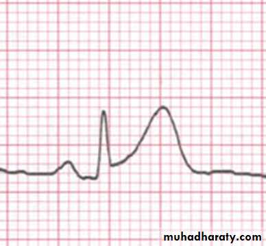 ECG