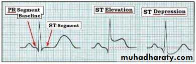 ECG
