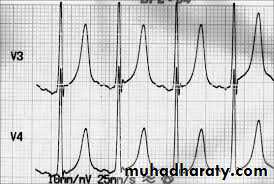 ECG