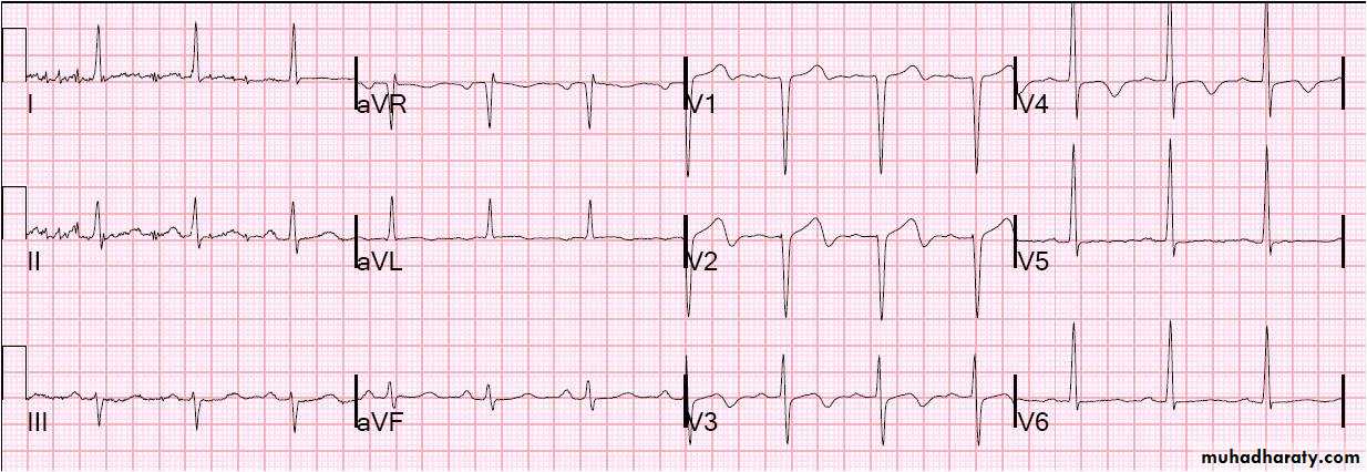 ECG