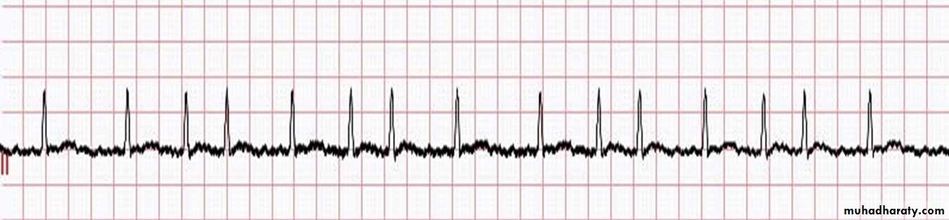 ECG
