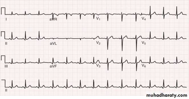 ECG