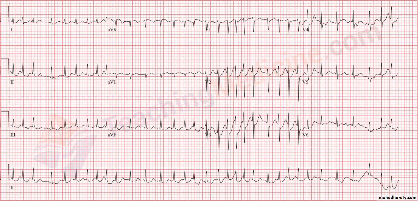 ECG